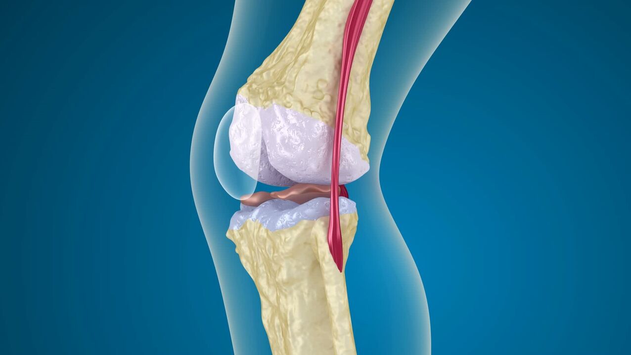 Καταστροφή της άρθρωσης του γόνατος στην οστεοαρθρίτιδα