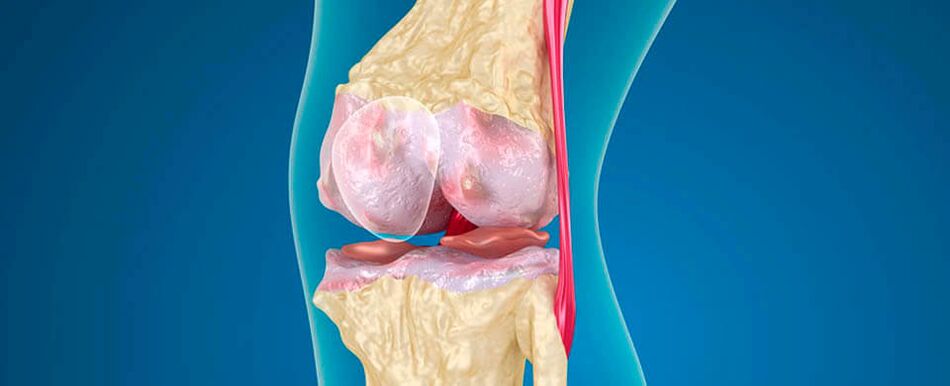 Η οστεοαρθρίτιδα του γόνατος ως αιτία πόνου