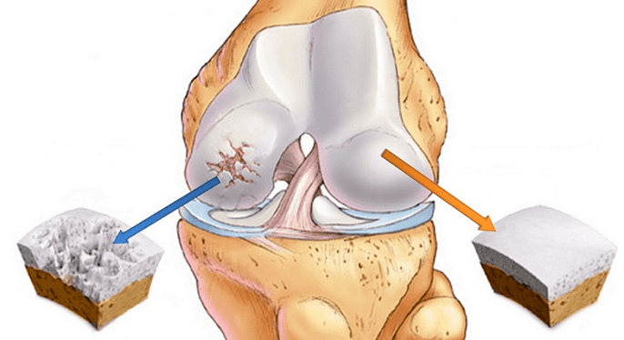 υγιής χόνδρος που επηρεάζεται από την οστεοαρθρίτιδα